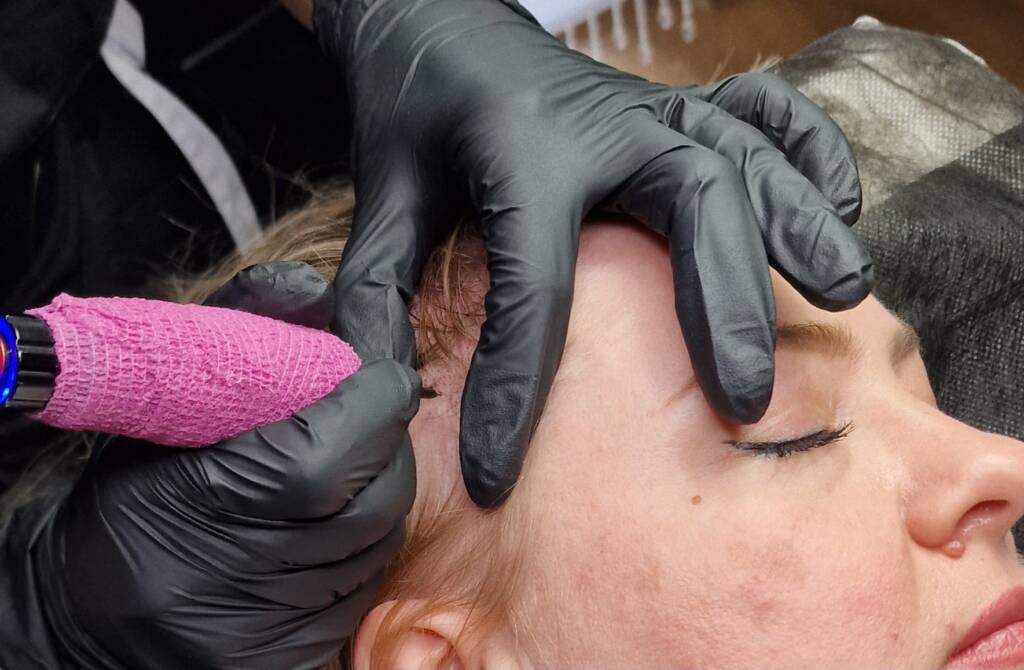 Scalp Micropigmentation for Women