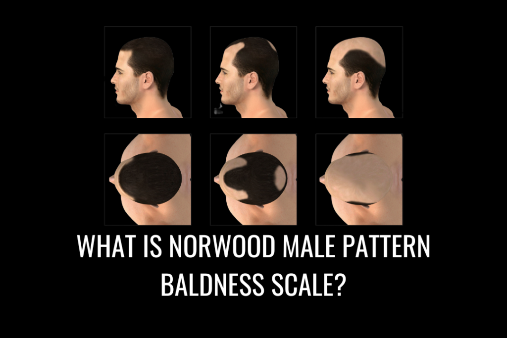 Norwood Scale: A Guide to Male Pattern Baldness