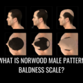 Understanding the Norwood Scale: A Guide to Male Pattern Baldness