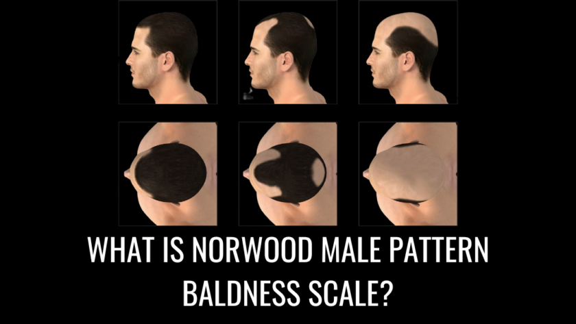 What Is the Norwood Scale?