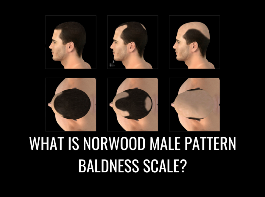 What Is the Norwood Scale?