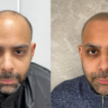 Scalp Micropigmentation Hairline – 5 Best SMP Hairlines for a Natural Look