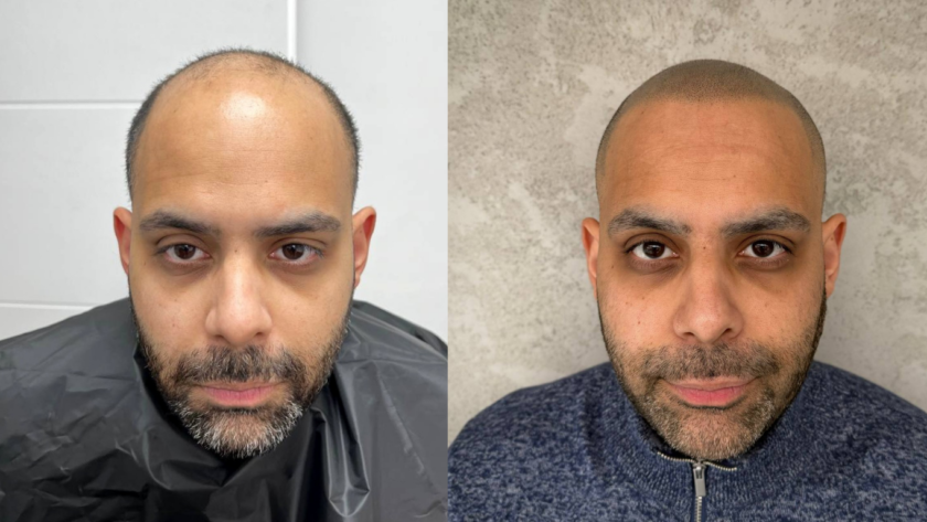 5 Best SMP Hairlines for a Natural Look
