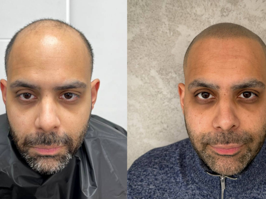 5 Best SMP Hairlines for a Natural Look