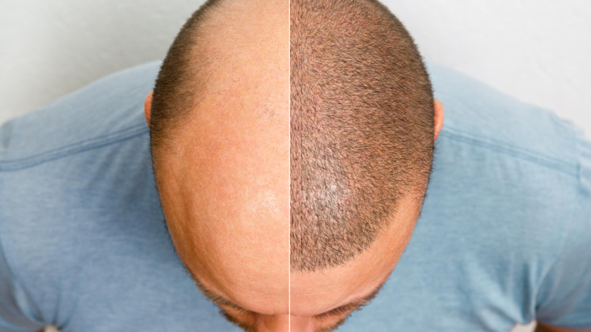 Scalp Micropigmentation men
