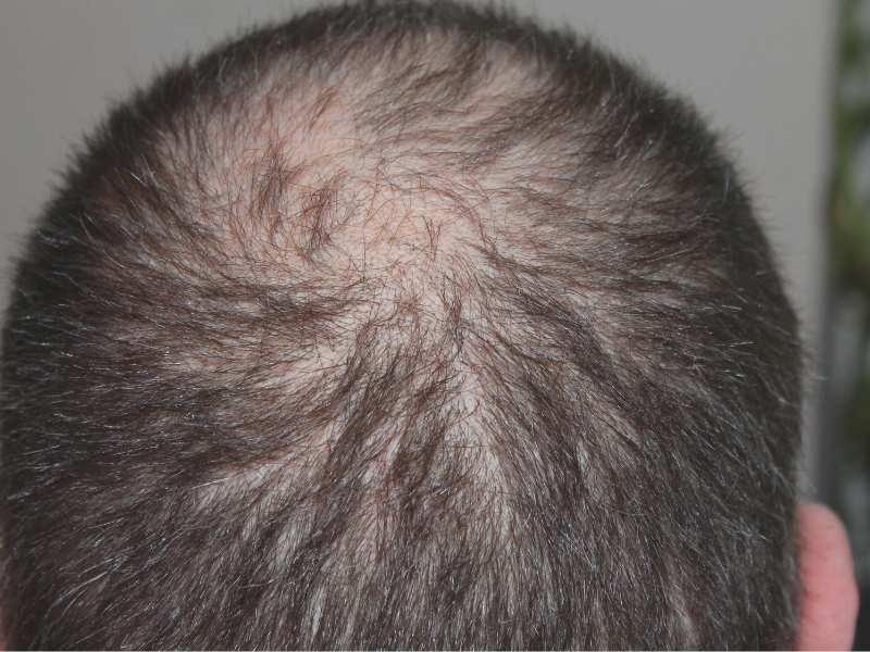 Hair Loss