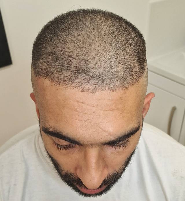 Density Enhancement After Hair Transplant